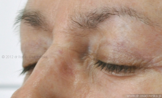 Upper eyelid surgery picture, 11 months after procedure. Laser Blepharoplasty, Elisabeth, 58 y.o.