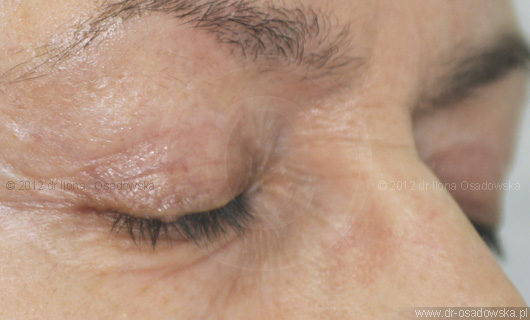 Upper eyelid surgery picture, 6 months after procedure. Laser Blepharoplasty, Elisabeth, 58 y.o.
