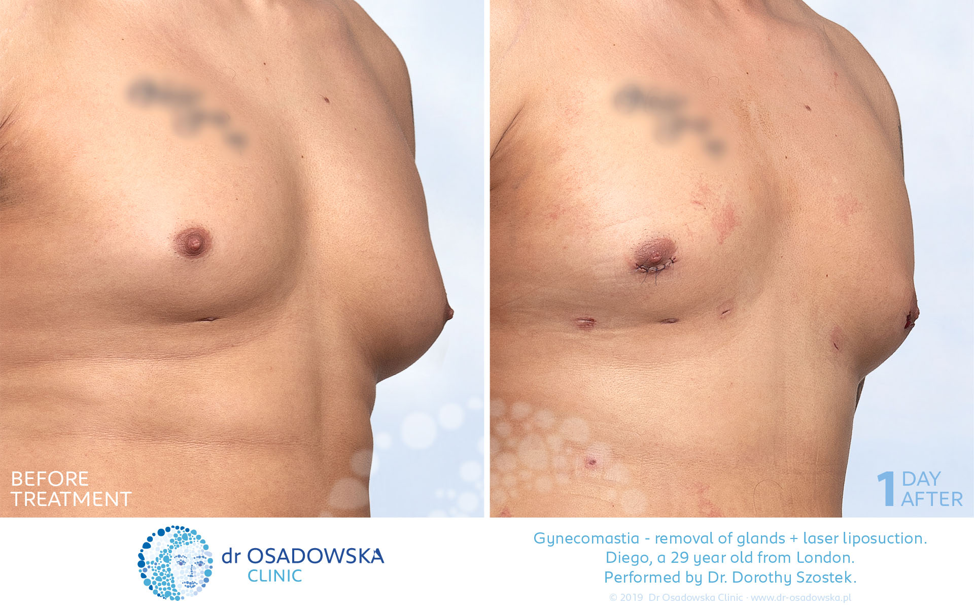 Gynecomastia of male breast and laser liposuction, LipoLife.  Pictures before and 1 day after surgery. Performed by Dr. Dorothy Szostek. Diego, London. 