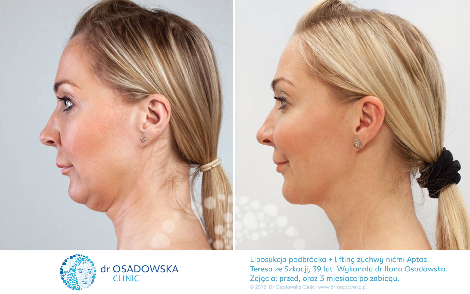Aptos Threads treatment effect pictures before and 3 months after procedure. Theresa, Scotland