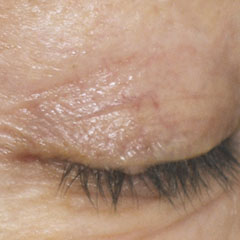 Upper eyelid laser surgery, Elisabeth - 6 and 11 months after.