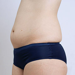 Liposuction for abdomen, 1 day after