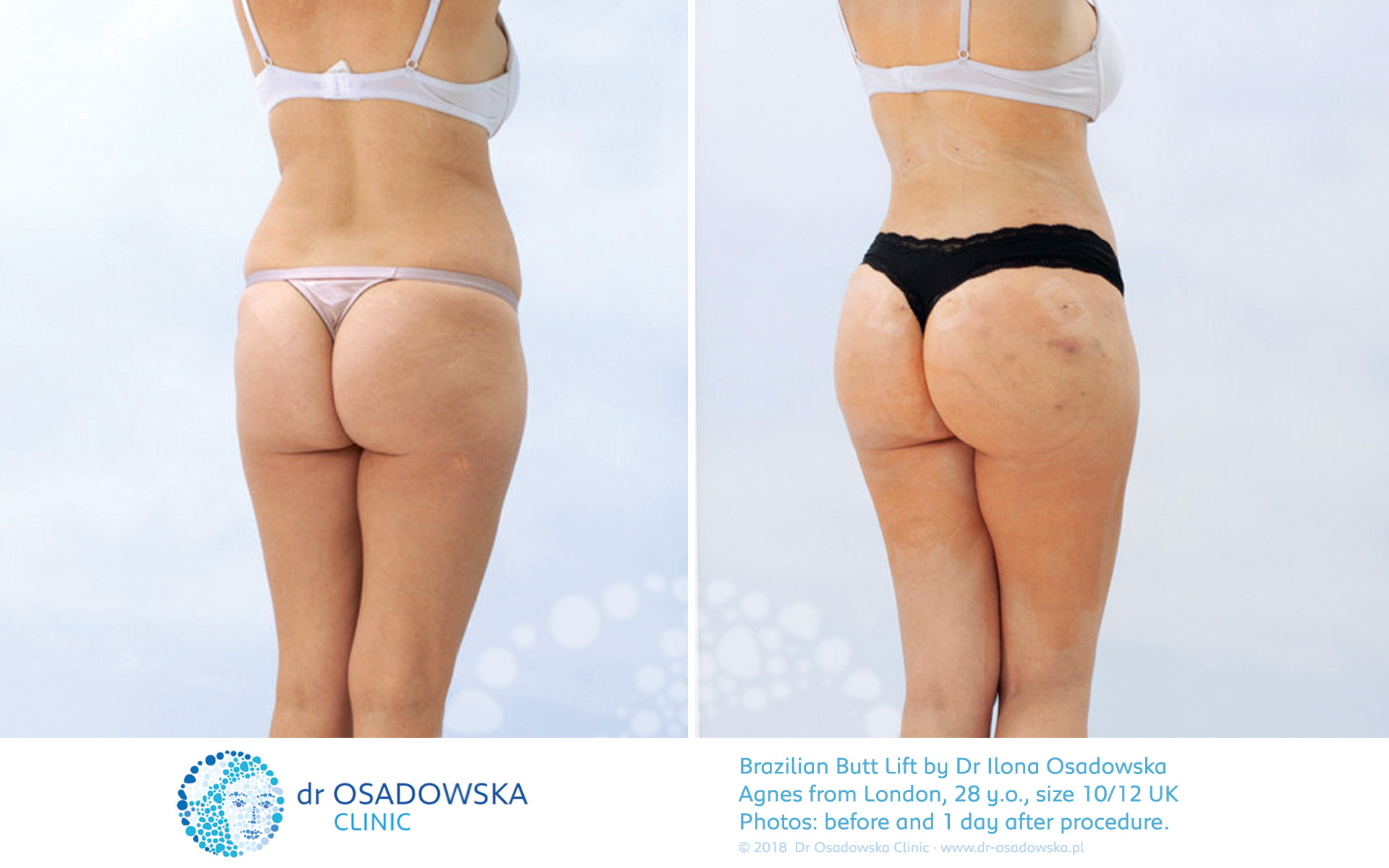 Non-Surgical Butt Lift London & UK, Non-Surgical BBL Price UK