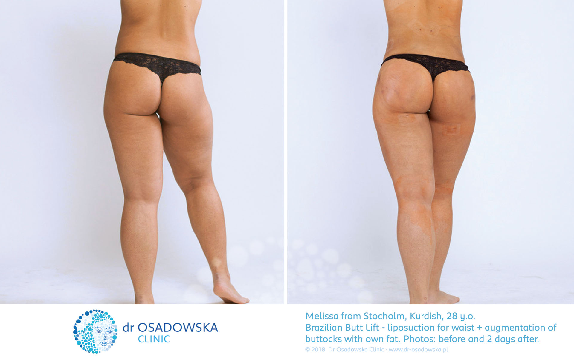 Buttock Augmentation, Brazilian Butt Lift Surgery