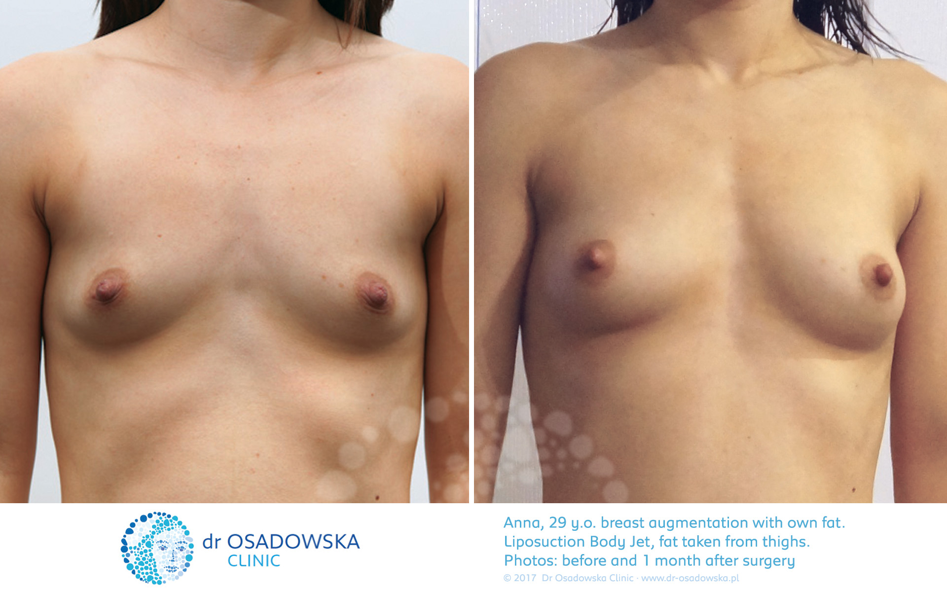 Breast augmentation with own fat - pictures before and one day after surgery. Laser liposuction LipoLife. Anna, a 29 year old from Poland living in the UK.