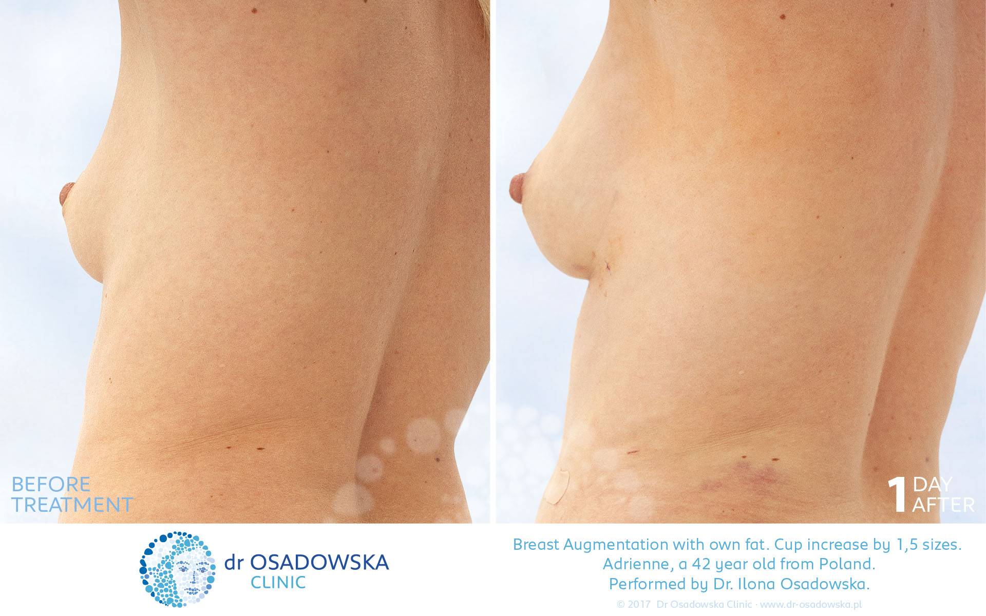 Breast augmentation with own fat - pictures before and one day after surgery. Laser liposuction LipoLife. Adrienne, a 42 year old from Poland.