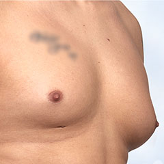 Gynecomastia - gland surgical removal + liposuction