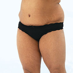 Liposuction of abdomen and waist, next day after 