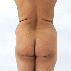 Brazilian Butt Lift for a mature woman