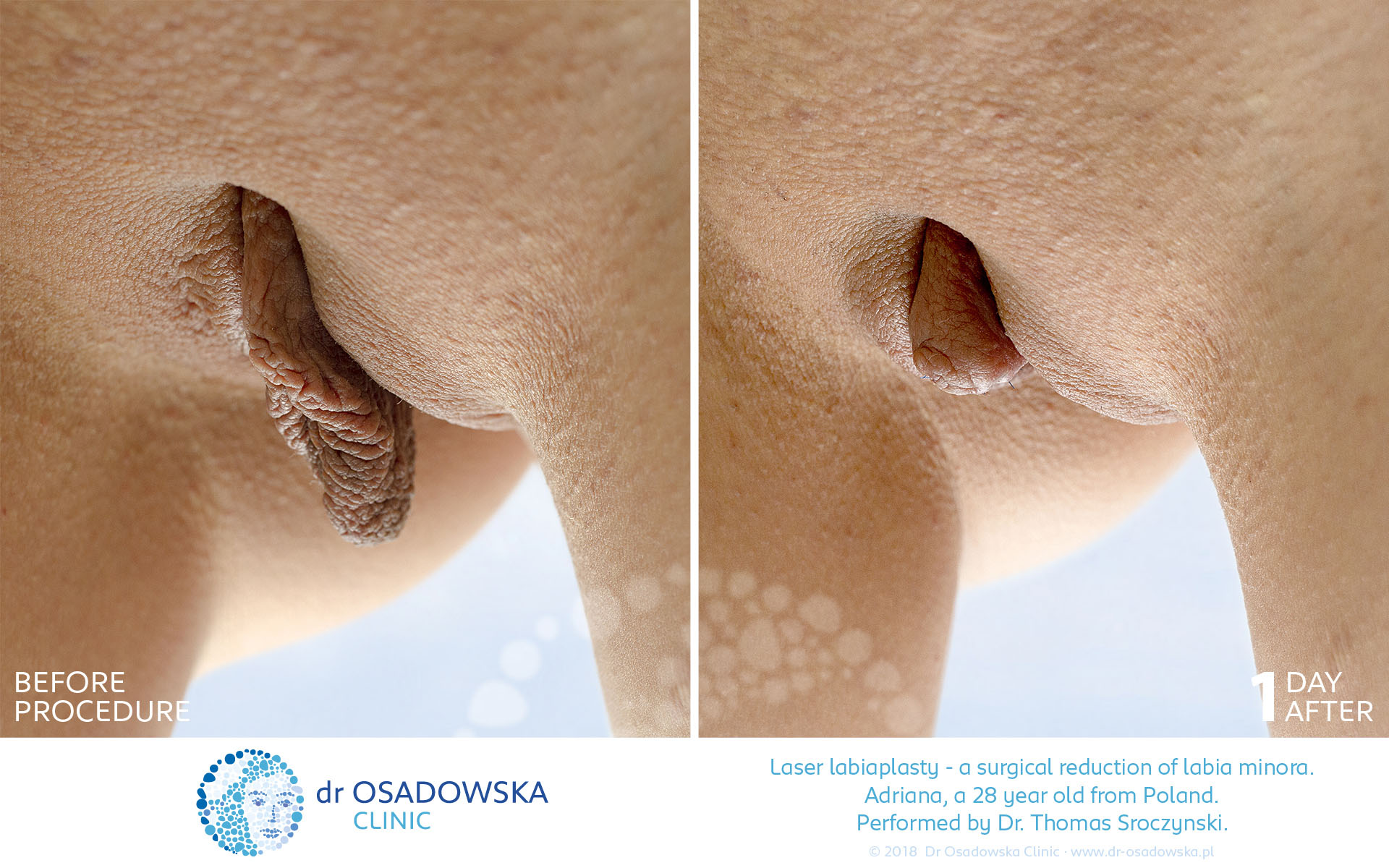 Laser Labiaplasty pictures before and 1 day after procedure. after. View B