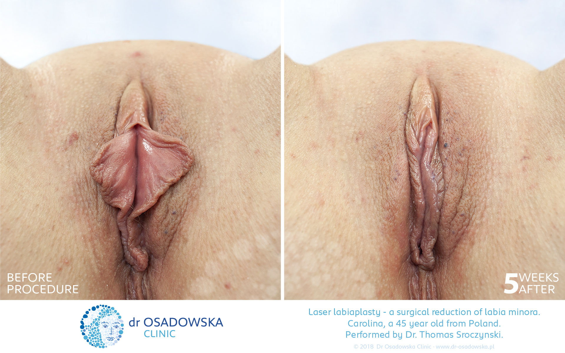 Laser Labiaplasty before and 5 weeks after. Carolina, 45 y.o. from Poland
