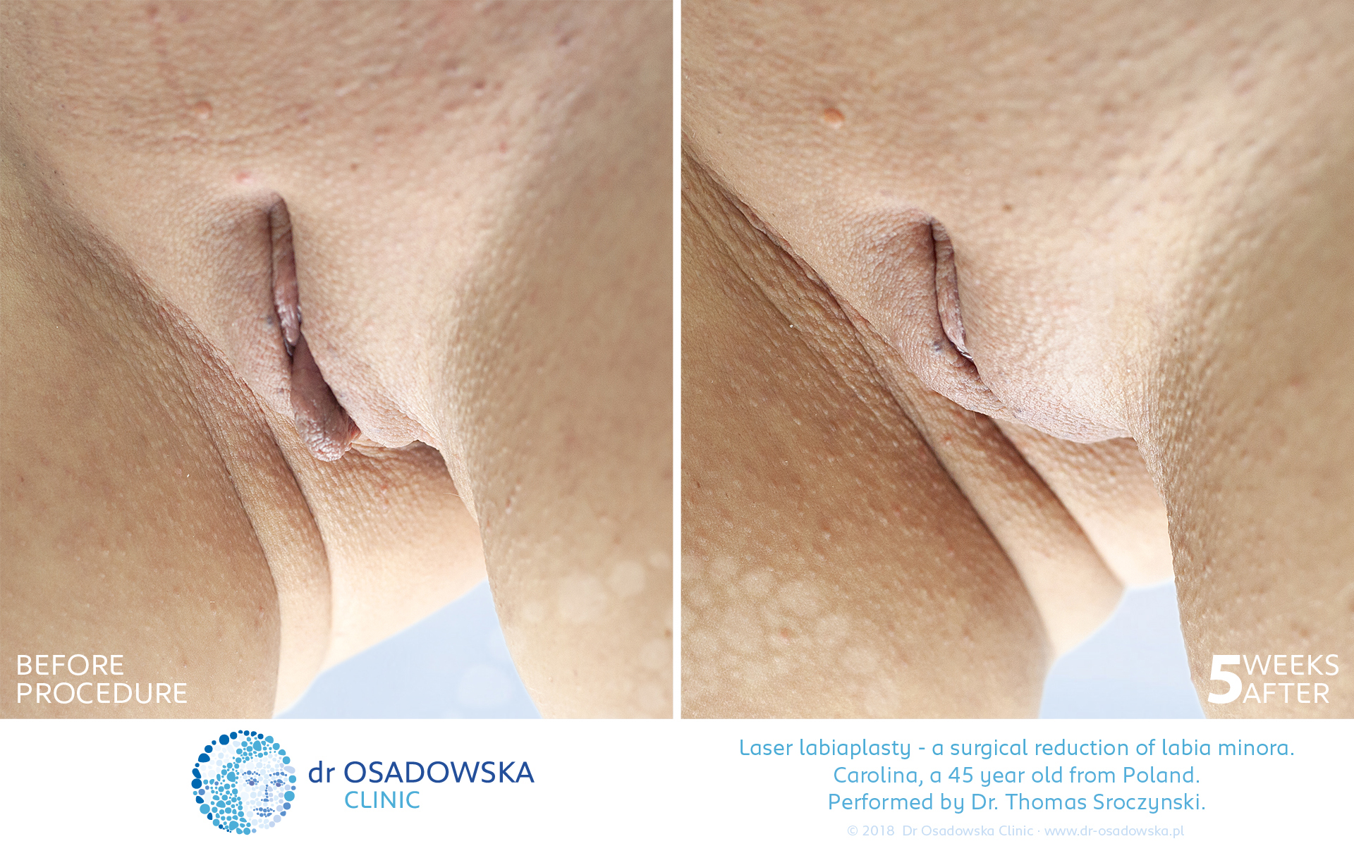 Laser Labiaplasty before and 5 weeks after. Carolina, 45 y.o. from Poland. View B