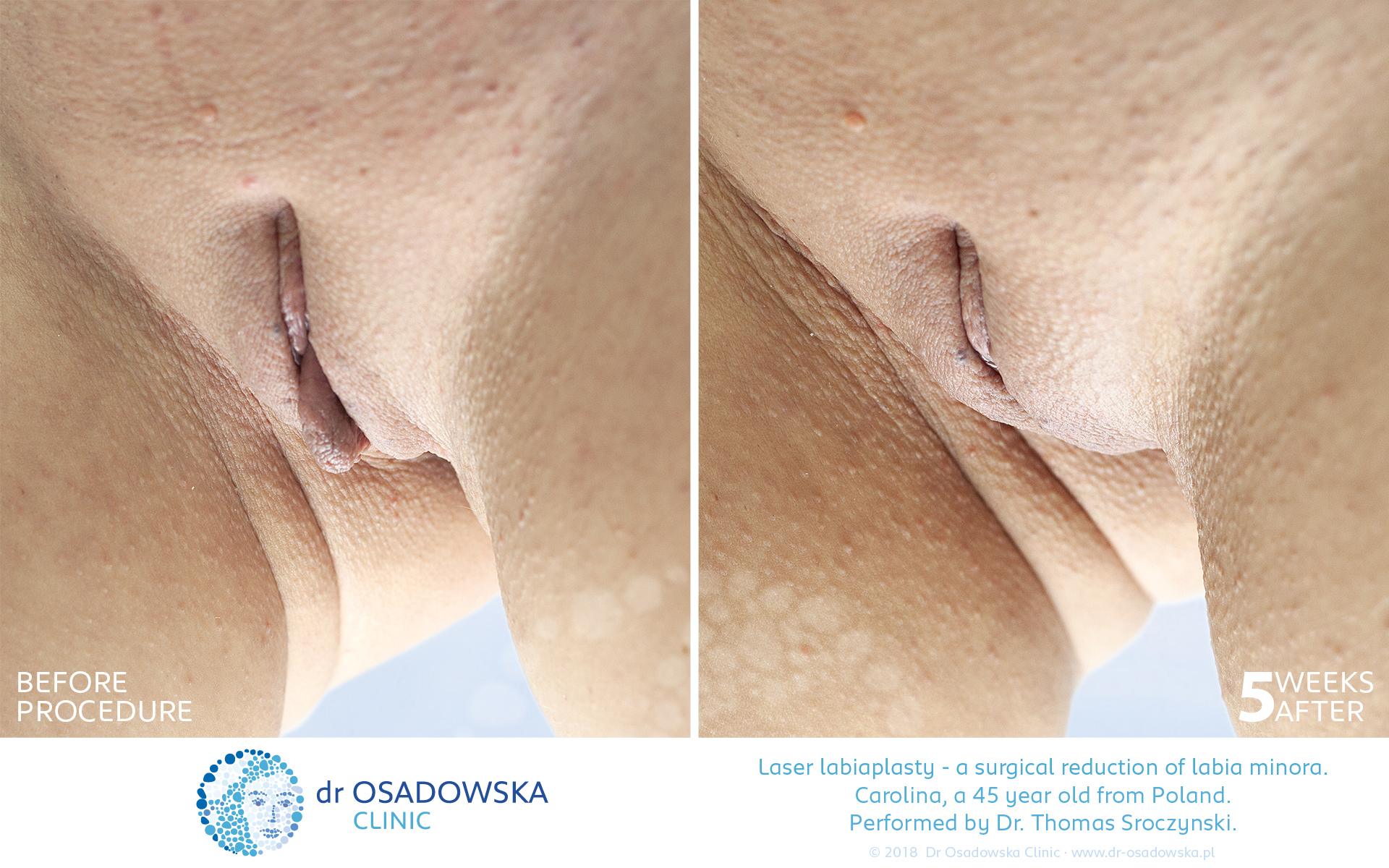 Real photos Laser Labiaplasty before and  weeks after, Carolina