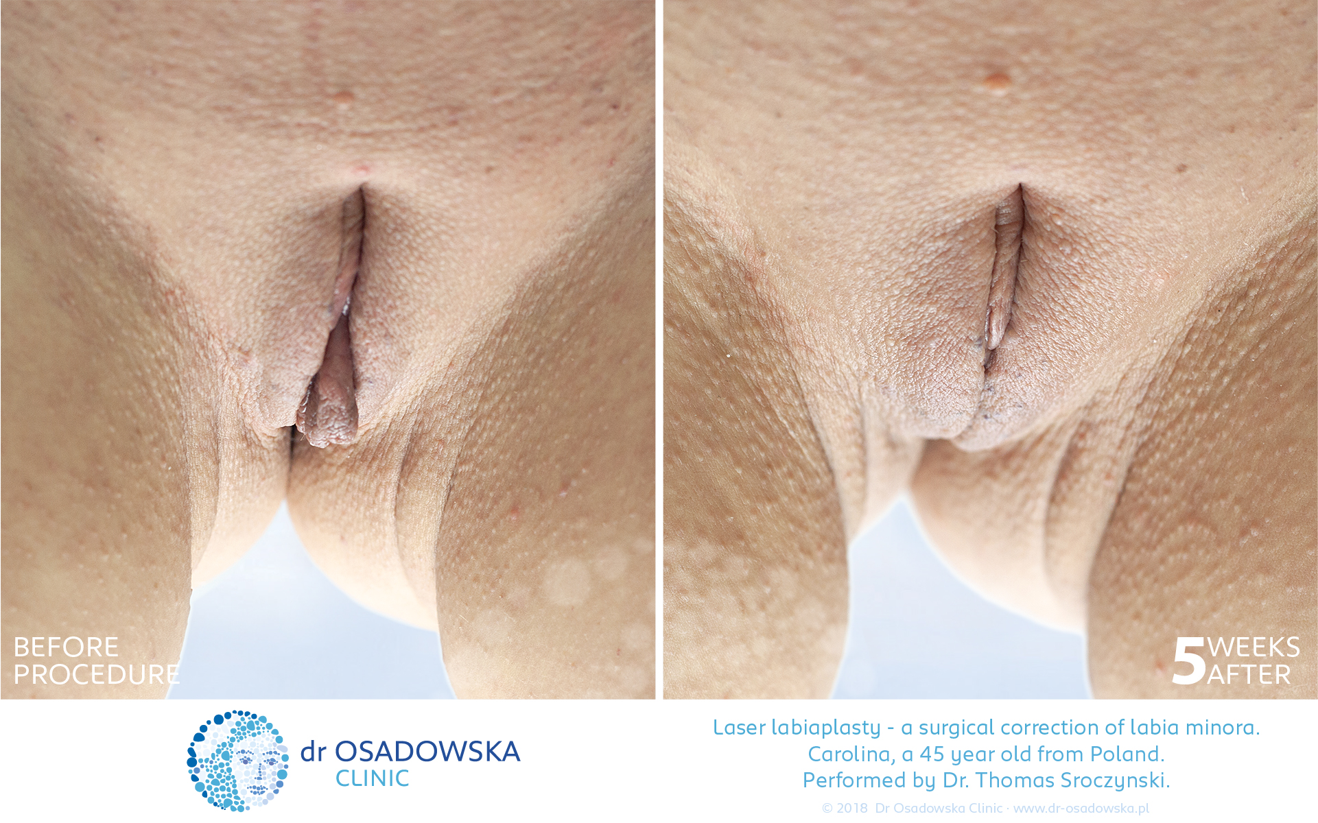 Laser Labiaplasty before and 5 weeks after. Carolina, 45 y.o. from Poland. View C