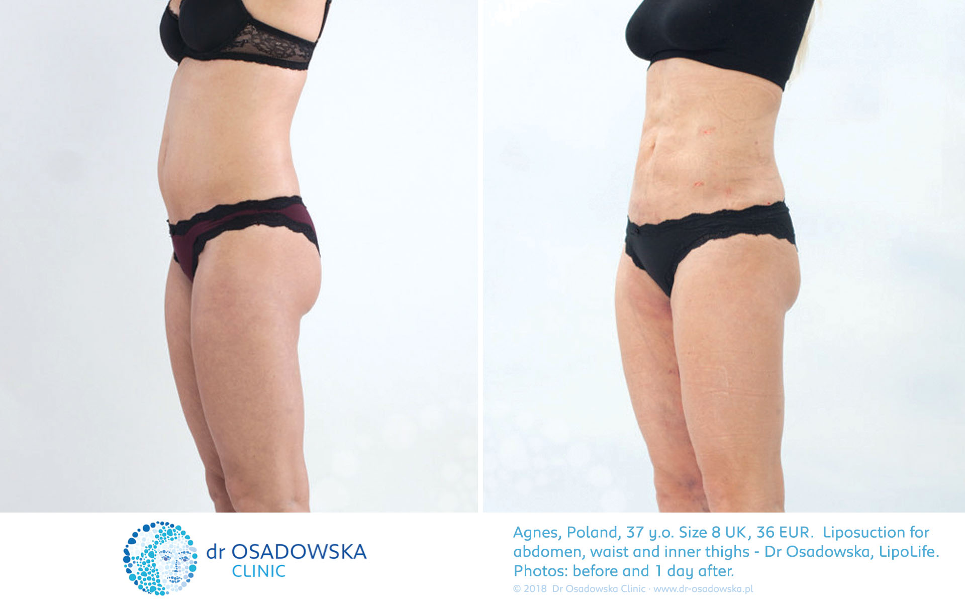 Liposuction of the 'love handles' or flanks