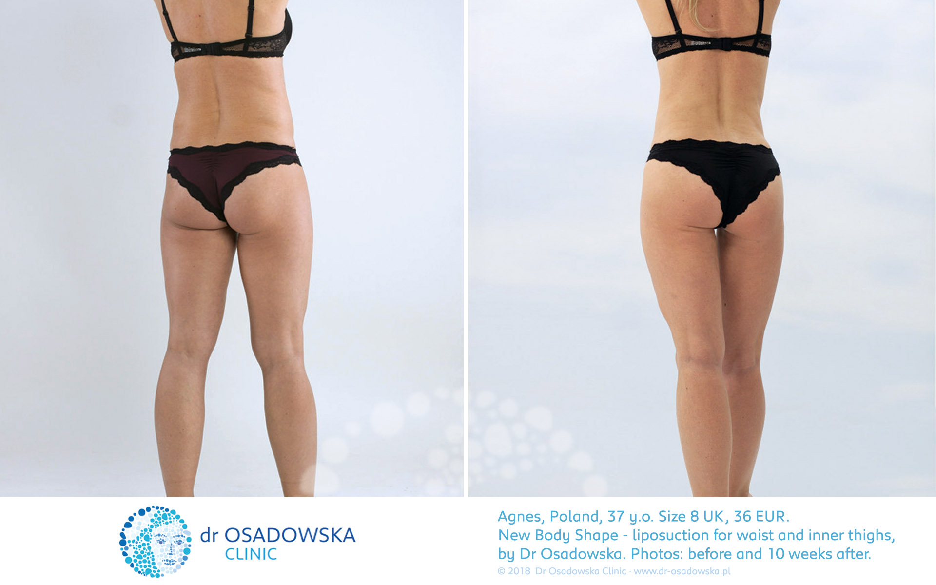 Waist - Love Handles Liposuction