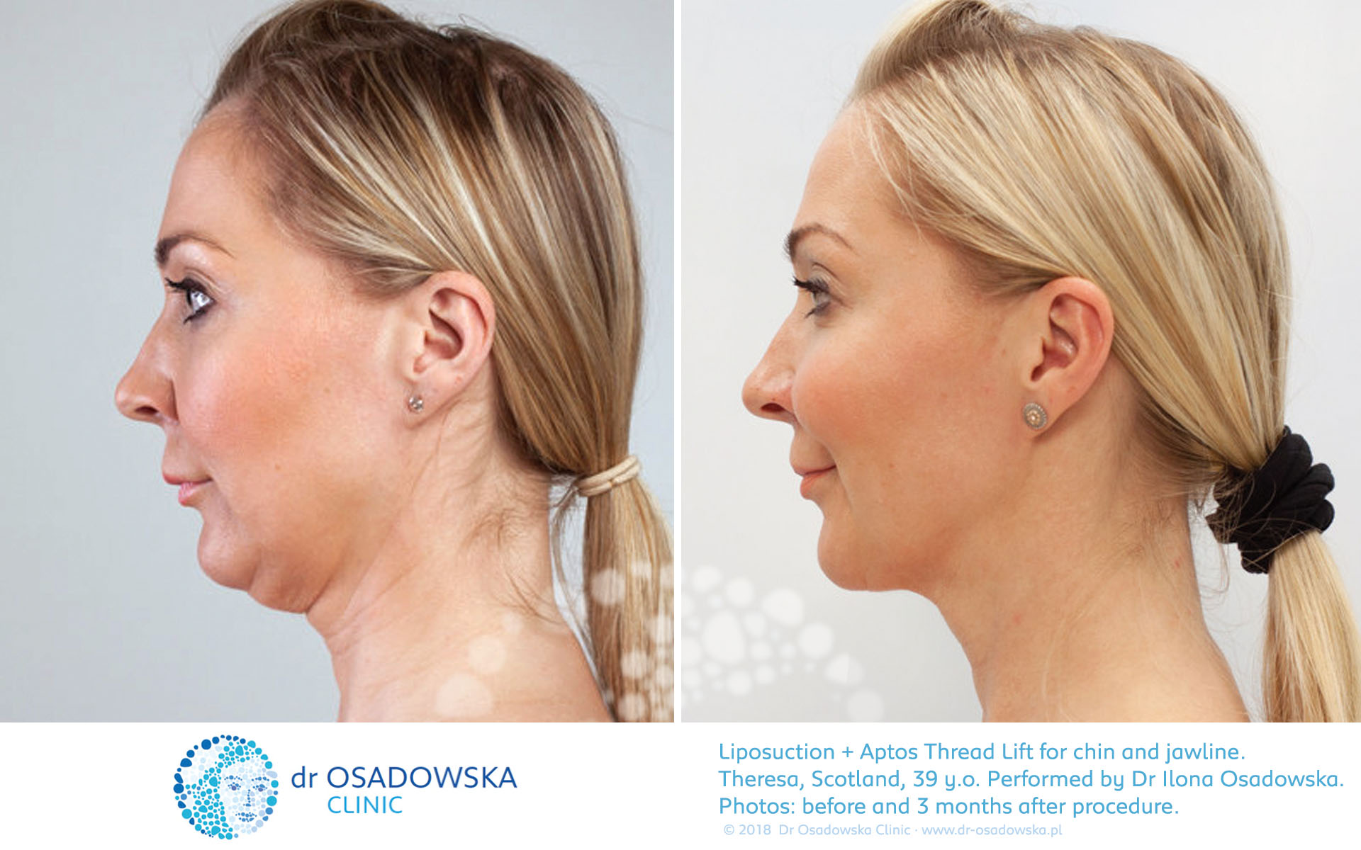 Liposuction for chin and jawls, then Thread Lift Aptos for neck and cheeks. Pictures before and 3 months after. Theresa, a a 39 year old from Scotland. (A)