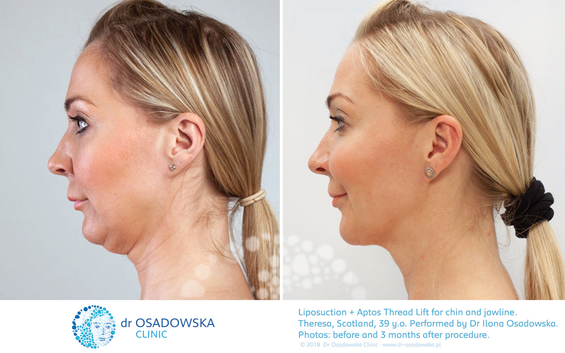 Real Photos Liposuction Of Chin And Jawline And Thread Lift Dr Osadowska Clinic Poland