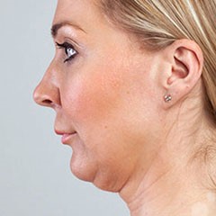 Liposuction of chin and jawline and Thread Lift