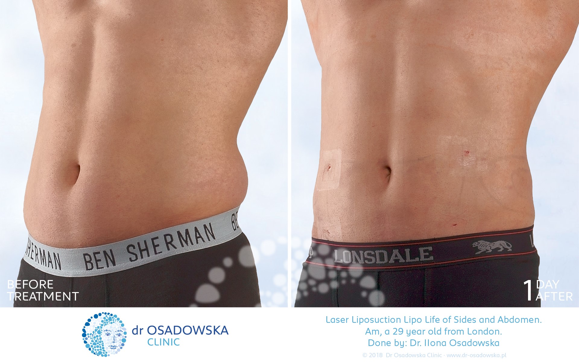 Liposuction abdomen flanks - sides, LipoLife, before and 1 day after. Am, a fitness instructor from the UK. 
