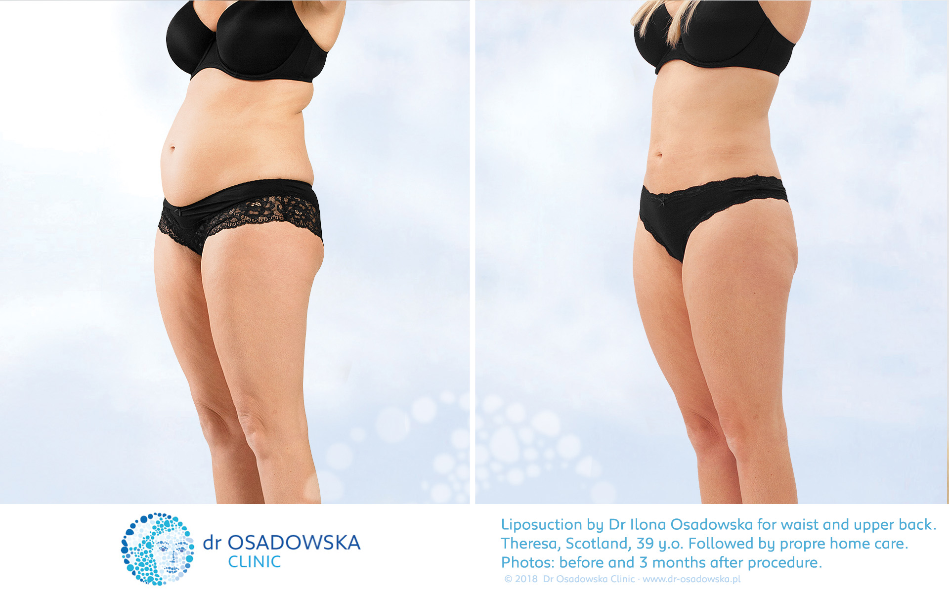 Liposuction abdomen flanks - sides, LipoLife, before after, 3 months. Theresa, Scotland.