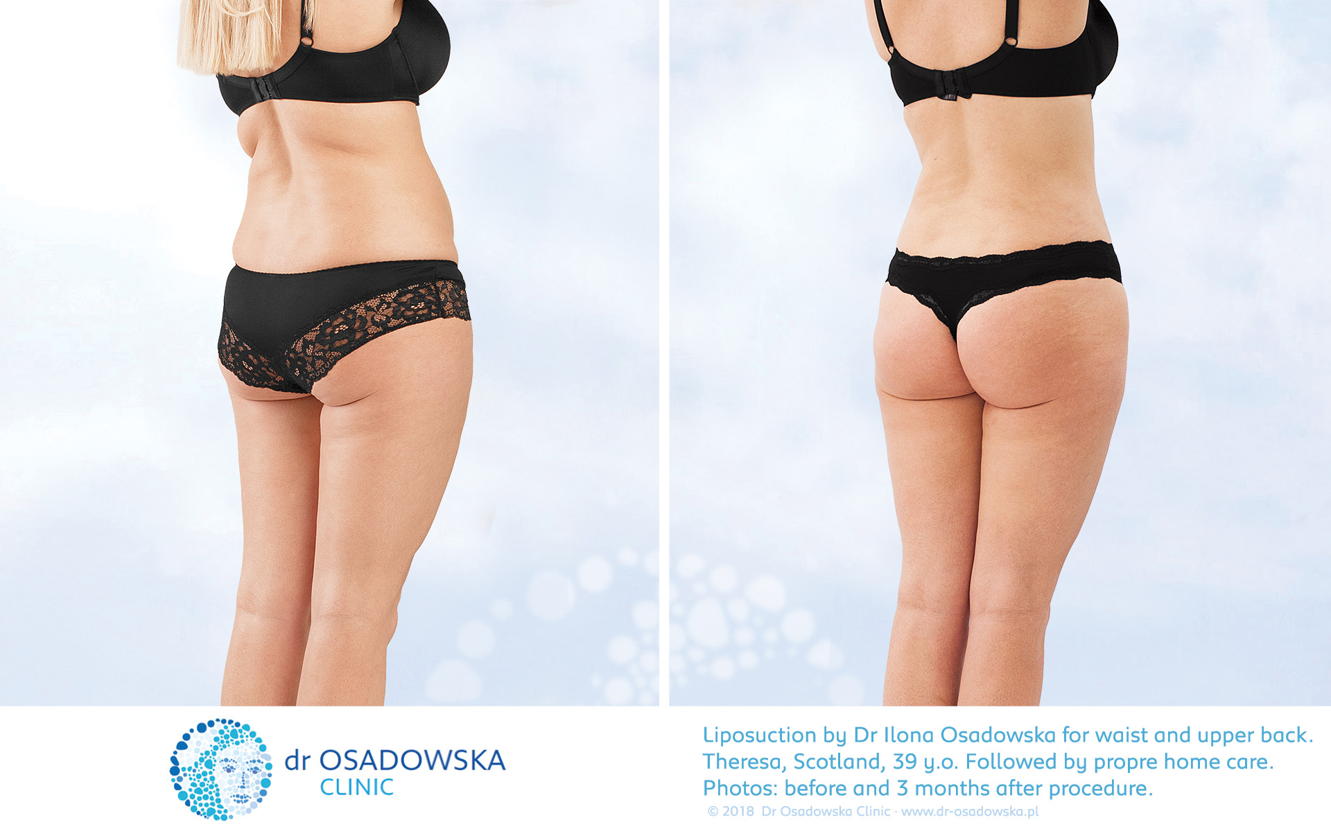 Liposuction of Flanks Before and After 3804