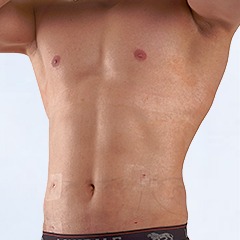Liposuction for male waist, Am