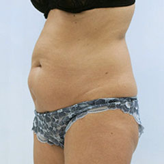 Liposuction of abdomen and waist one year after - Margaret